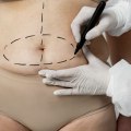 Non Surgical Liposuction: The Expert's Perspective on Age Restrictions