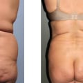 Is getting liposuction worth it?