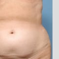 Is lipo worth the risk?