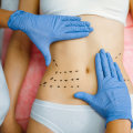 The Recovery Process for Non Surgical Liposuction: What to Expect