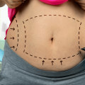 The Truth About Non Surgical Liposuction: Are the Results Permanent?