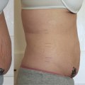 The Truth About Non-Surgical Liposuction Results