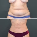 Does liposuction work on belly fat?