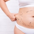 The Truth About Non Surgical Liposuction: Is There a Minimum or Maximum BMI Requirement?