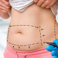 Why can't i get liposuction?