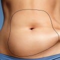 How much does liposuction cost in the uk?