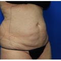 Can lipo remove 50 pounds?