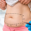 Non Surgical Liposuction: Targeting Specific Areas of the Body