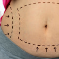 When Can You Resume Normal Activities After Non-Surgical Liposuction?