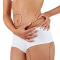 What is the minimum weight to get liposuction?