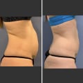 The Truth Behind Non Surgical Liposuction Success Rate