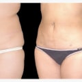 What will i look like after liposuction?