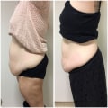 Non Surgical Liposuction: Separating Fact from Fiction