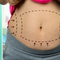 The Benefits of Non Surgical Liposuction: A Comprehensive Guide