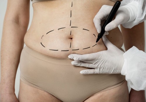 Non Surgical Liposuction: The Expert's Perspective on Age Restrictions