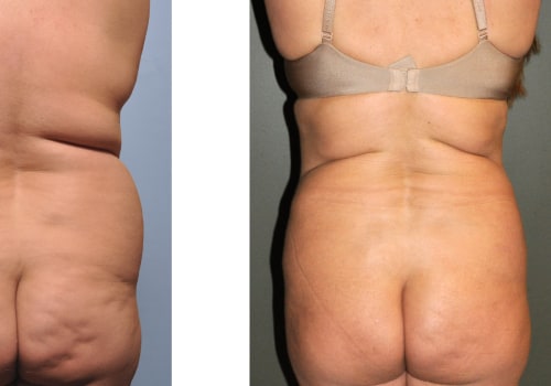 Is getting liposuction worth it?