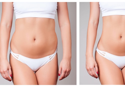 Non-Surgical Liposuction: Understanding Pre-Existing Medical Conditions