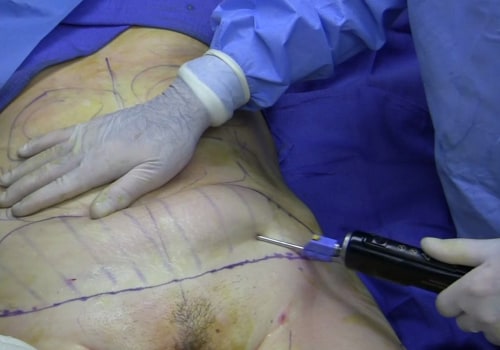 How much fat can be removed with liposuction in the uk?