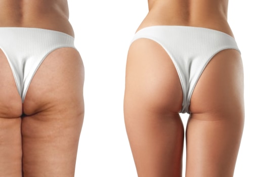 Non Surgical Liposuction: A Revolutionary Treatment for Cellulite