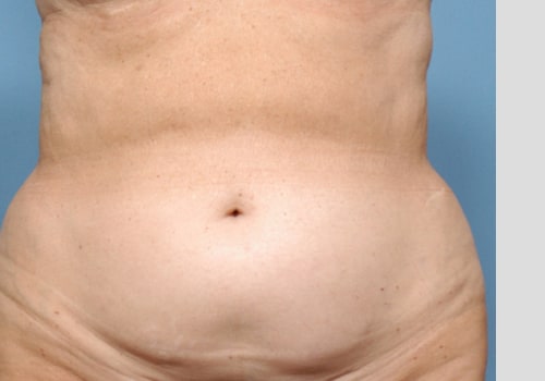 Is lipo worth the risk?