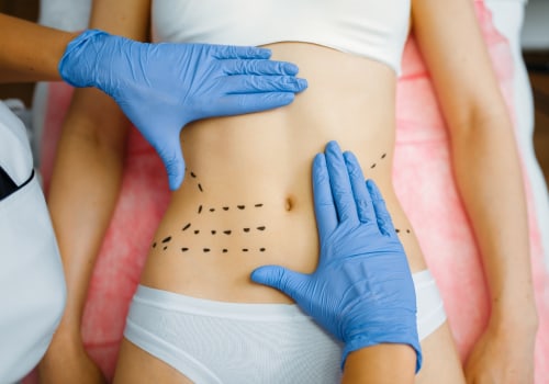 The Recovery Process for Non Surgical Liposuction: What to Expect