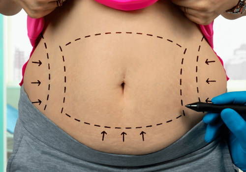 The Truth About Non Surgical Liposuction: Are the Results Permanent?