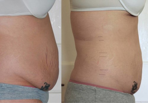 The Truth About Non-Surgical Liposuction Results