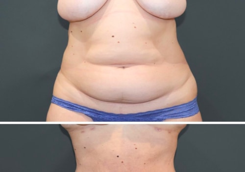 Does liposuction work on belly fat?