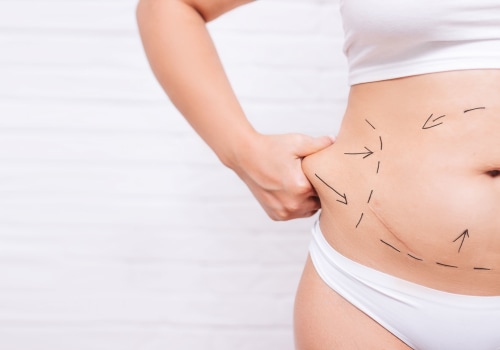 The Truth About Non Surgical Liposuction: Is There a Minimum or Maximum BMI Requirement?