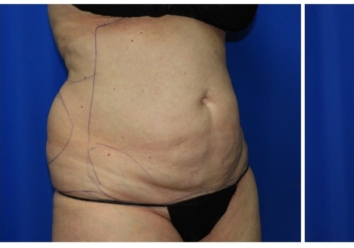 Can lipo remove 50 pounds?