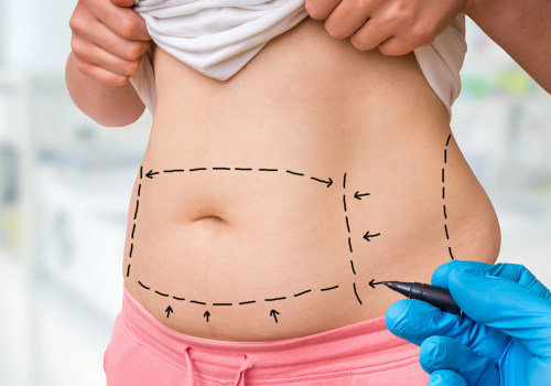 Non Surgical Liposuction: Targeting Specific Areas of the Body