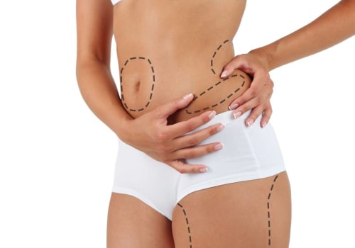 What is the minimum weight to get liposuction?