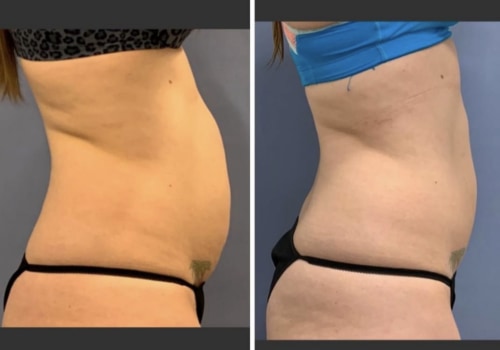 The Truth Behind Non Surgical Liposuction Success Rate