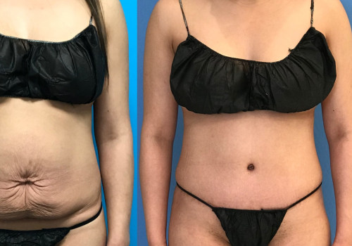 Is lipo on the stomach worth it?