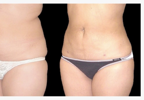 What will i look like after liposuction?