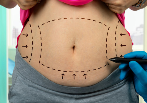 The Ultimate Guide to Non Surgical Liposuction: What You Need to Know